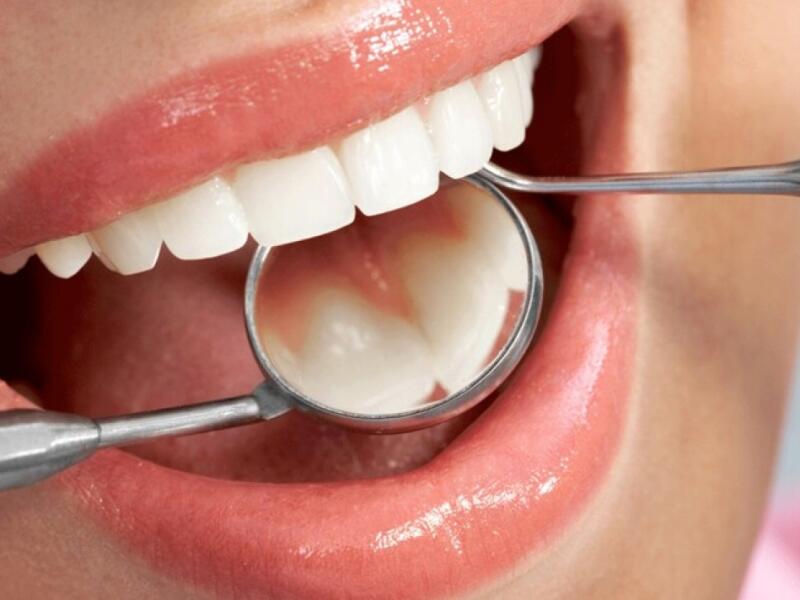 Prophylaxie dentaire - Caries ... Chirurgien dentiste à Javea